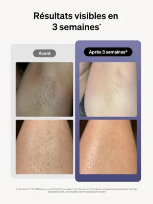 Résultats avant et après utilisation de l'épilateur Ulike.